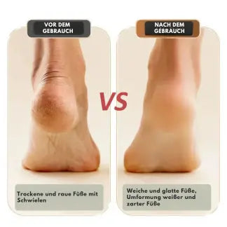 Sikunuo | Electric Callus Remover